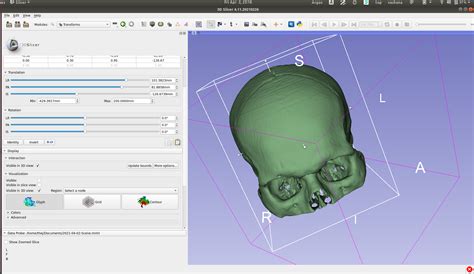 democratiz3d|dicom to stl 3d slicer.